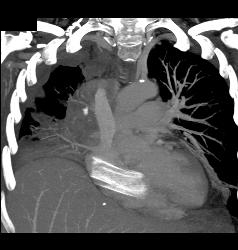 Inferior Vena Cava (IVC) Stent Has Migrated Into the Right Ventricle - CTisus CT Scan