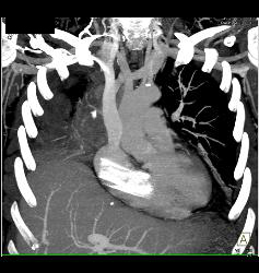 Inferior Vena Cava (IVC) Stent Has Migrated Into the Right Ventricle - CTisus CT Scan