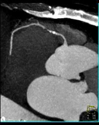 Critical RCA Stenosis in A Few Perspectives - CTisus CT Scan