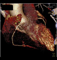 Critical RCA Stenosis in A Few Perspectives - CTisus CT Scan