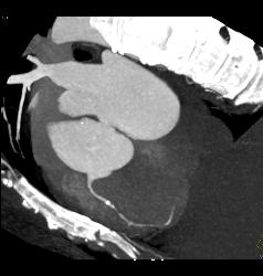 Critical RCA Stenosis in A Few Perspectives - CTisus CT Scan