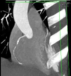 Critical RCA Stenosis in A Few Perspectives - CTisus CT Scan