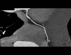 Critical RCA Stenosis in A Few Perspectives - CTisus CT Scan