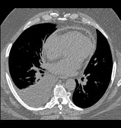 Pericardial Thickening and Constrictive Pericarditis Leads to Failure - CTisus CT Scan