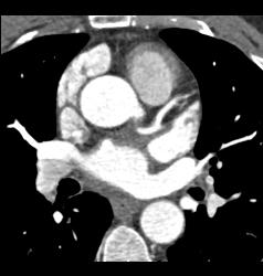 Left Anterior Descending Coronary Artery (LAD) Disease in A Few Renderings - CTisus CT Scan