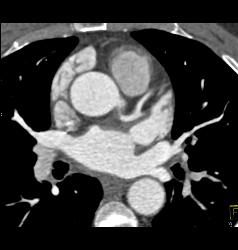 Left Anterior Descending Coronary Artery (LAD) Disease in A Few Renderings - CTisus CT Scan