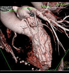 Left Anterior Descending Coronary Artery (LAD) Disease in A Few Renderings - CTisus CT Scan