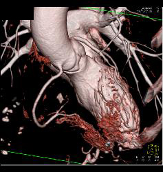 Aortic Valve Disease - CTisus CT Scan