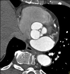 Plaque Aortic Root and Right Coronary Artery (RCA) - CTisus CT Scan