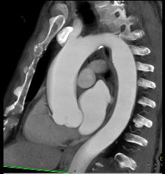 Plaque Aortic Root and Right Coronary Artery (RCA) - CTisus CT Scan