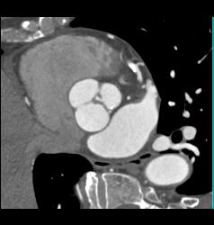 Thickened Valve Leaflet - CTisus CT Scan