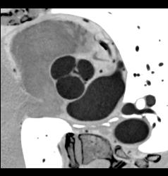 Thickened Aortic Valve - CTisus CT Scan