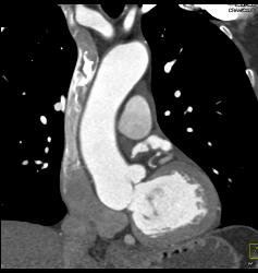 Normal Atrial Appendage - CTisus CT Scan