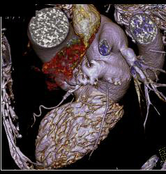 Normal Atrial Appendage - CTisus CT Scan