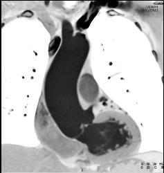 Thickened Aortic Valve - CTisus CT Scan