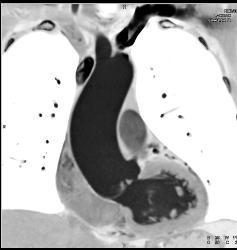 Thickened Aortic Valve - CTisus CT Scan