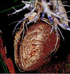 Thickened Aortic Valve - CTisus CT Scan