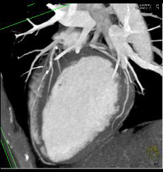 Coronary Artery Disease With Plaque - CTisus CT Scan