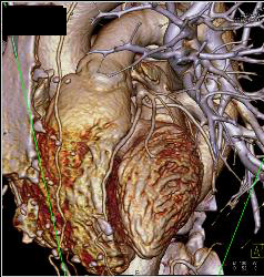 Coronary Artery Disease With Plaque - CTisus CT Scan