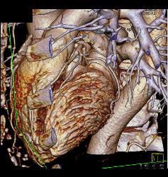 Coronary Artery Disease With Plaque - CTisus CT Scan