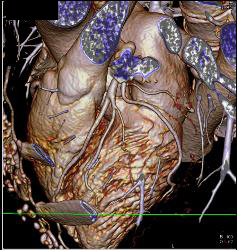 Coronary Artery Disease With Plaque - CTisus CT Scan