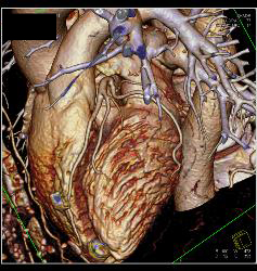 Normal Left Anterior Descending Coronary Artery (LAD) - CTisus CT Scan