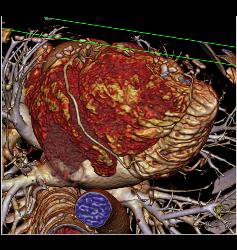 Posterior Basal View Shows RCA With Branches - CTisus CT Scan