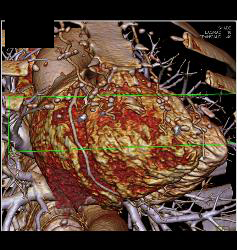 Posterior Basal View Shows RCA With Branches - CTisus CT Scan