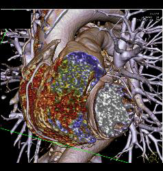 Posterior Basal View Shows RCA With Branches - CTisus CT Scan