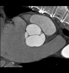 Bicuspid Valve - CTisus CT Scan