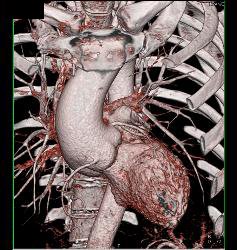 Dilated Aortic Root With Normal Origin of Coronary Arteries. Patient Had Marfan Syndrome and A Bicuspid Valve. - CTisus CT Scan