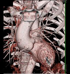 Dilated Aortic Root With Normal Origin of Coronary Arteries. Patient Had Marfan Syndrome and A Bicuspid Valve. - CTisus CT Scan