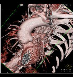 Dilated Aortic Root With Normal Origin of Coronary Arteries. Patient Had Marfan Syndrome and A Bicuspid Valve. - CTisus CT Scan