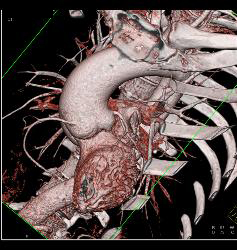 Dilated Aortic Root With Normal Origin of Coronary Arteries. Patient Had Marfan Syndrome and A Bicuspid Valve. - CTisus CT Scan