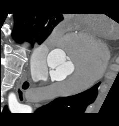 Dilated Aortic Root With Normal Origin of Coronary Arteries. Patient Had Marfan Syndrome and A Bicuspid Valve. - CTisus CT Scan