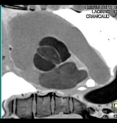 Dilated Aortic Root With Normal Origin of Coronary Arteries. Patient Had Marfan Syndrome and A Bicuspid Valve. - CTisus CT Scan