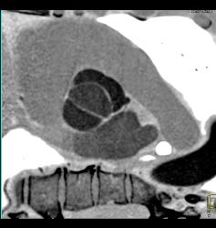 Dilated Aortic Root With Normal Origin of Coronary Arteries. Patient Had Marfan Syndrome and A Bicuspid Valve. - CTisus CT Scan