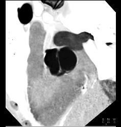 Normal Bicuspid Valve Opening and Closing - CTisus CT Scan