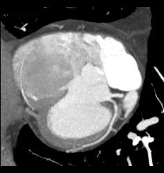 Left Anterior Descending Coronary Artery (LAD) and Circumflex Artery (CX) Arise Directly Off of the Left Cusp - CTisus CT Scan