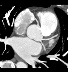 Left Anterior Descending Coronary Artery (LAD) and Circumflex Artery (CX) Arise Directly Off of the Left Cusp - CTisus CT Scan