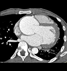 Dilated Aortic Root - CTisus CT Scan