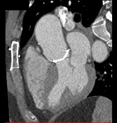 Aortic Valve Replacement - CTisus CT Scan