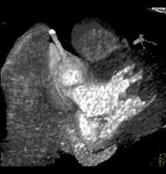 Anomalous Origin of the Left Coronary Artery - CTisus CT Scan