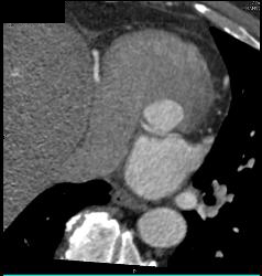 Anomalous Origin of the Left Coronary Artery - CTisus CT Scan