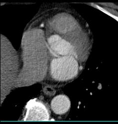 Anomalous Origin of the Left Coronary Artery - CTisus CT Scan