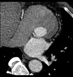 Anomalous Origin of the Left Coronary Artery - CTisus CT Scan