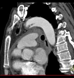 Clot in the Aortic Arch - CTisus CT Scan