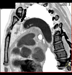 Clot in the Aortic Arch - CTisus CT Scan