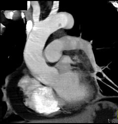 Clot in the Aortic Arch - CTisus CT Scan