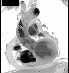 Clot in the Aortic Arch - CTisus CT Scan